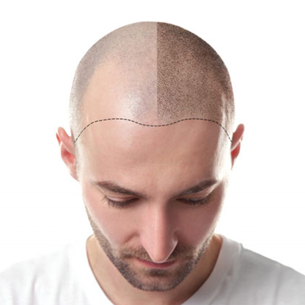 Saç Simülasyon Kursu | Saçlı Görünüm, Scalp Micropigmentation, SMP | İGU